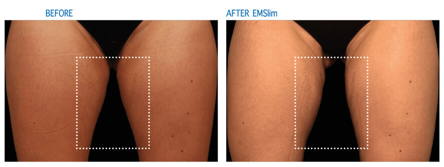 EMSlim Treatment Thighs Effect