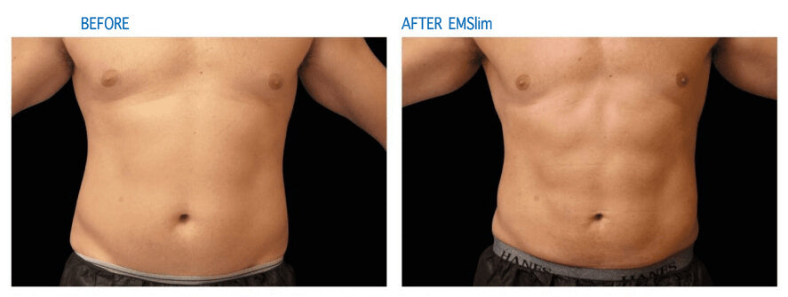 EMSlim Treatment Abdomen Effect
