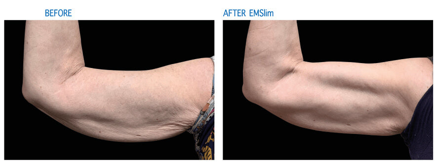 EMSlim Treatment Arm Effect