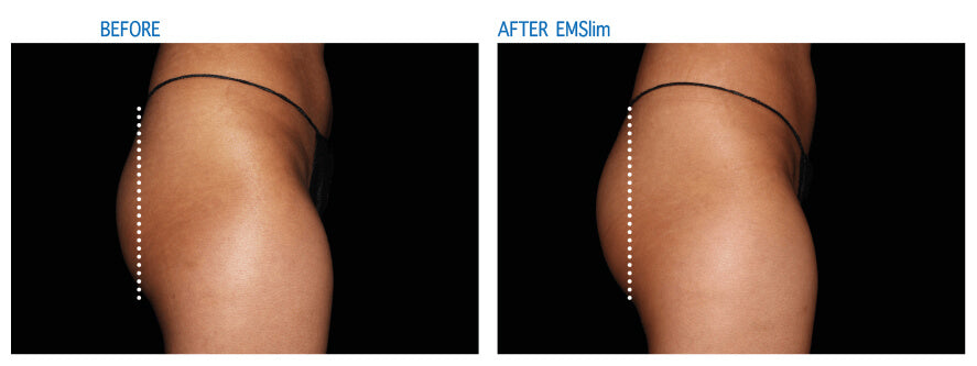 EMSlim Treatment Buttocks Effect